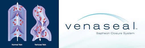 Thread Veins Treatment Belfast: The Vein Clinic Ni